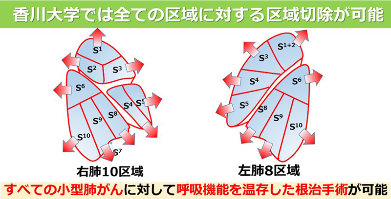香川大学では全ての区域に対する区域切除が可能（右肺10区域・左肺8区域）