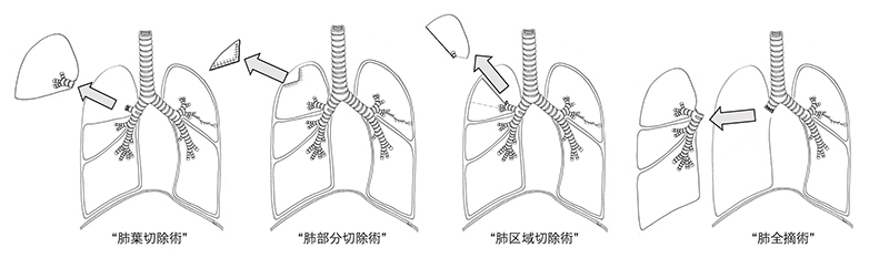 肺癌の手術術式（肺葉切除術・肺部分切除術・肺区域切除術・肺全摘術）