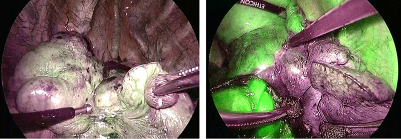 ICG赤外光胸腔鏡による区域間同定の蛍光比較