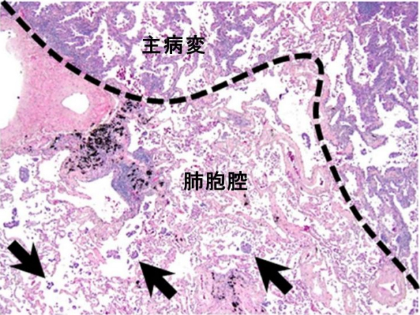 主病変から肺胞腔に癌細胞が進展している形態をSTAS（矢印）と定義