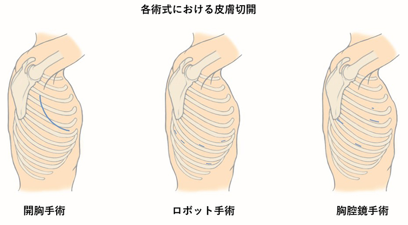 各術式における皮膚切開（開胸手術・ロボット手術・胸腔鏡手術）